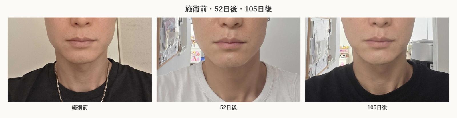 施術前・52日後・105日後のフェイスライン比較