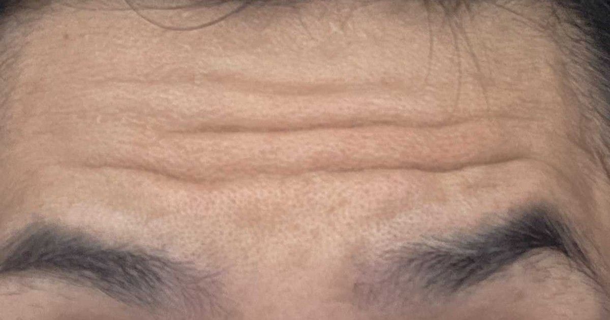 ボトックス約2ヶ月後。眉を上げても笑っても、額と目尻のしわはまだ出ていた