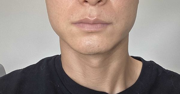 デンシティ翌日レポート。顎まわりが、なんか軽い気がする