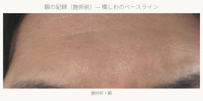 ボトックス施術前の額