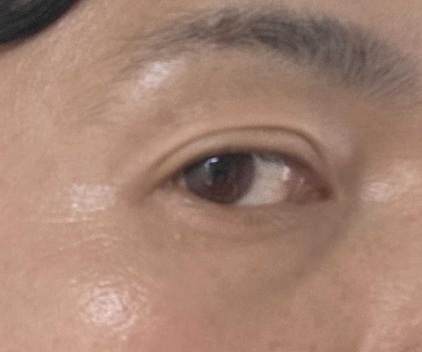 ボトックス施術前の目尻と目の下