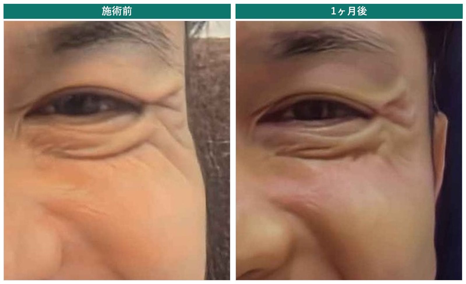ボトックス施術前と1ヶ月後の目尻の比較