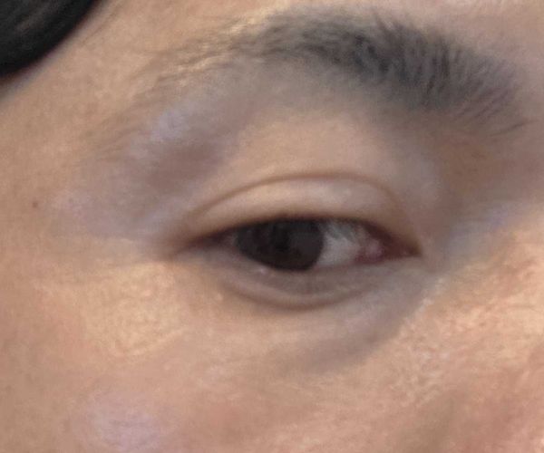 ボトックス施術直後の目尻と目の下