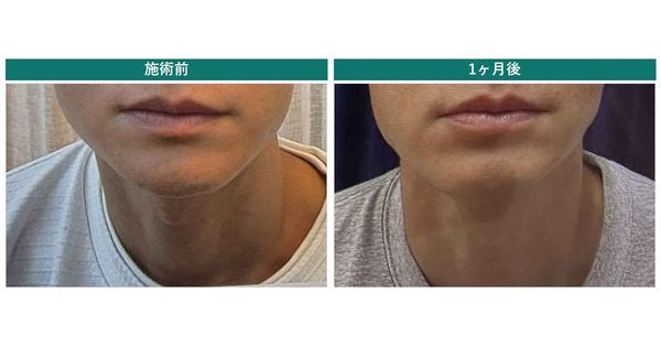 ボトックス1ヶ月後の検診レポート