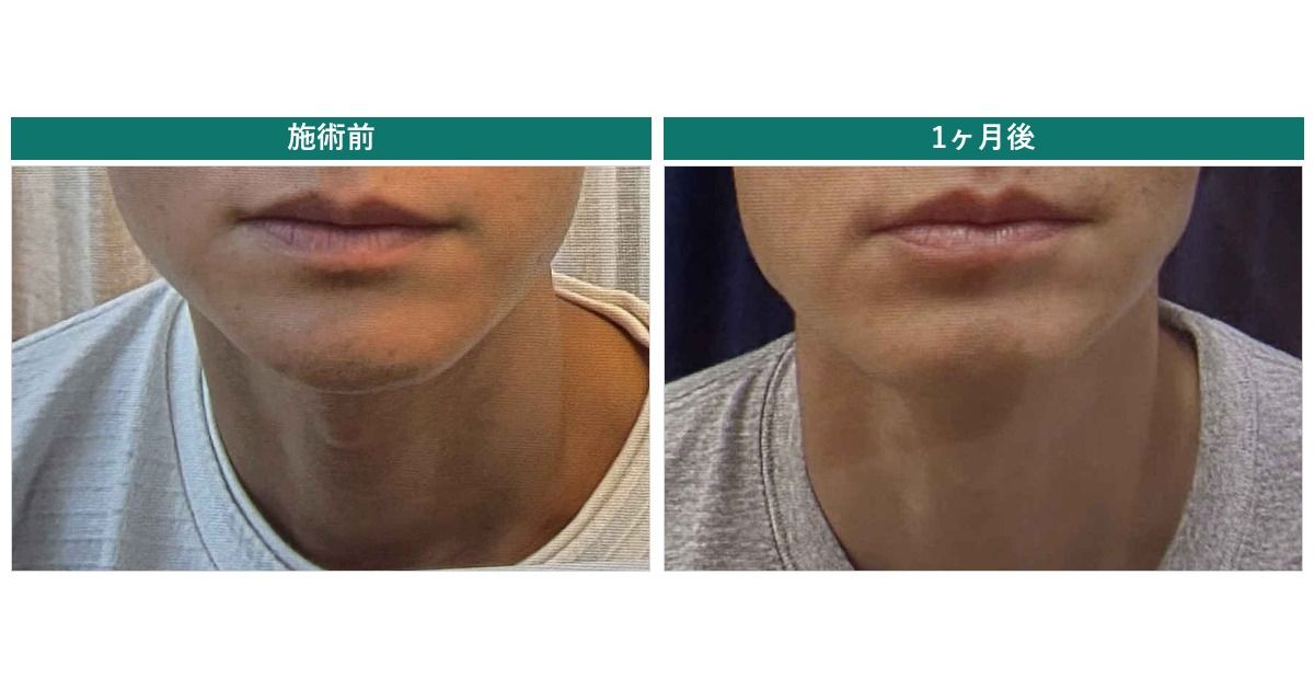 ボトックス1ヶ月後の検診レポート