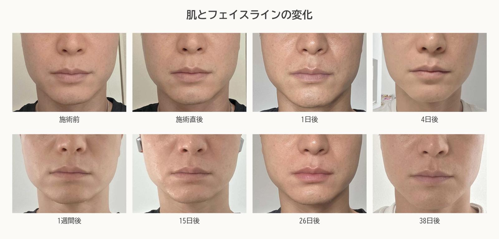 施術前から38日後までの肌とフェイスラインの変化
