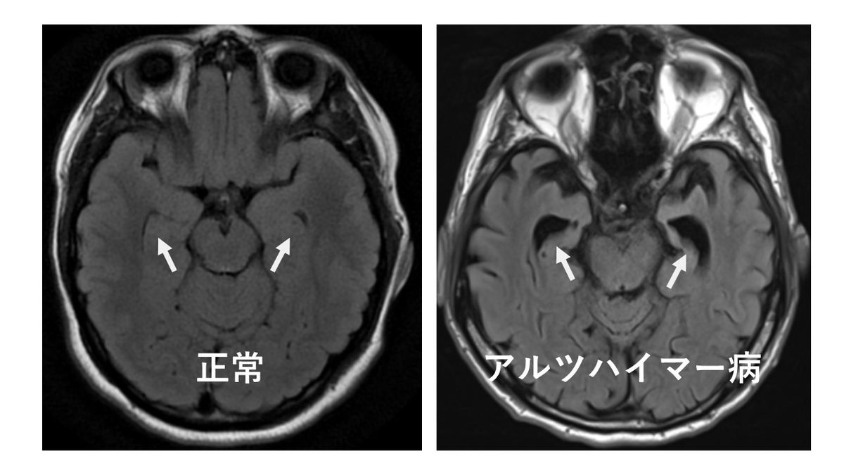 認知症 診断 病院で行われるMRI脳検査の様子