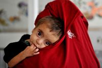 Malnutrition Worsens in 26 Afghan Provinces, OCHA Reports