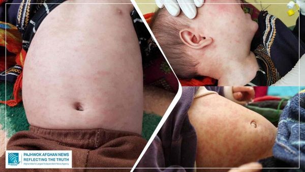 Measles Cases Rise in Afghanistan's Ghor Province, 994 Children Hospitalized in 10 Months