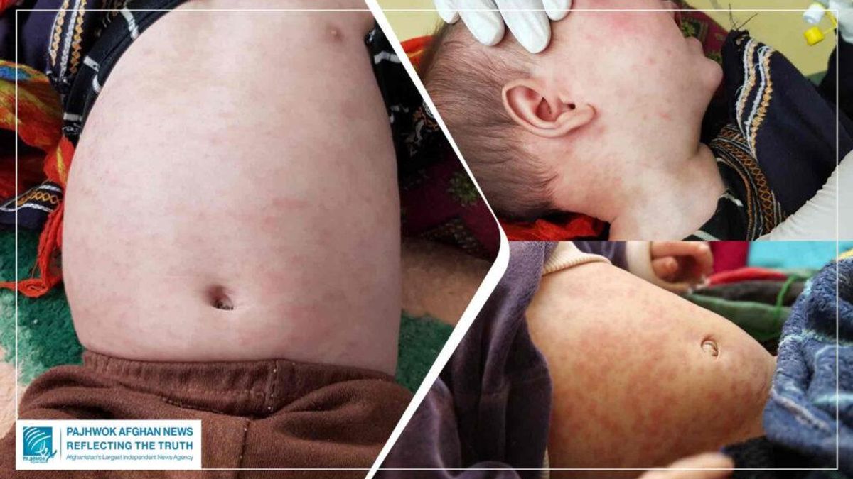 Measles Cases Rise in Afghanistan's Ghor Province, 994 Children Hospitalized in 10 Months