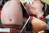 Measles Cases Rise in Afghanistan's Ghor Province, 994 Children Hospitalized in 10 Months