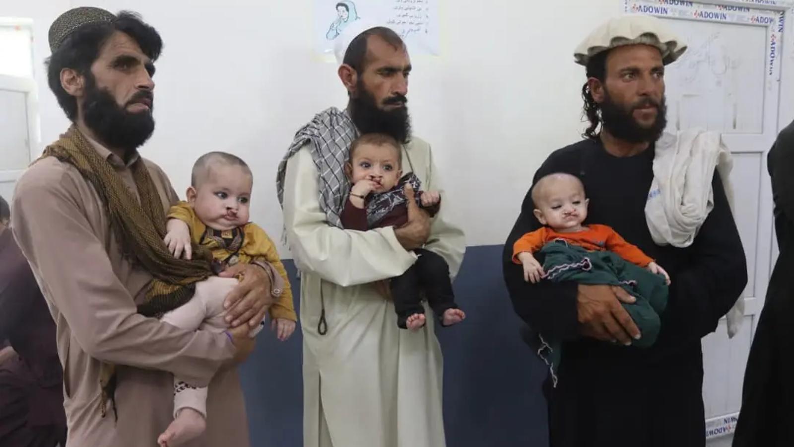 Free Surgical Treatment Planned for 250 Cleft Lip and Palate Patients in Khost
