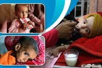 MSF Reports More Than 30 Percent Rise in Severe Child Malnutrition in Southern Afghanistan