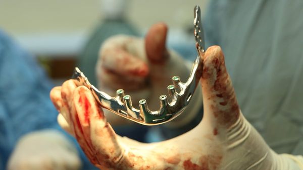 Dawood Khan Hospital Performs First Successful Lower Jaw Reconstruction Using Custom Implant