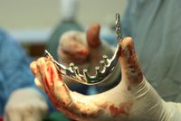 Dawood Khan Hospital Performs First Successful Lower Jaw Reconstruction Using Custom Implant