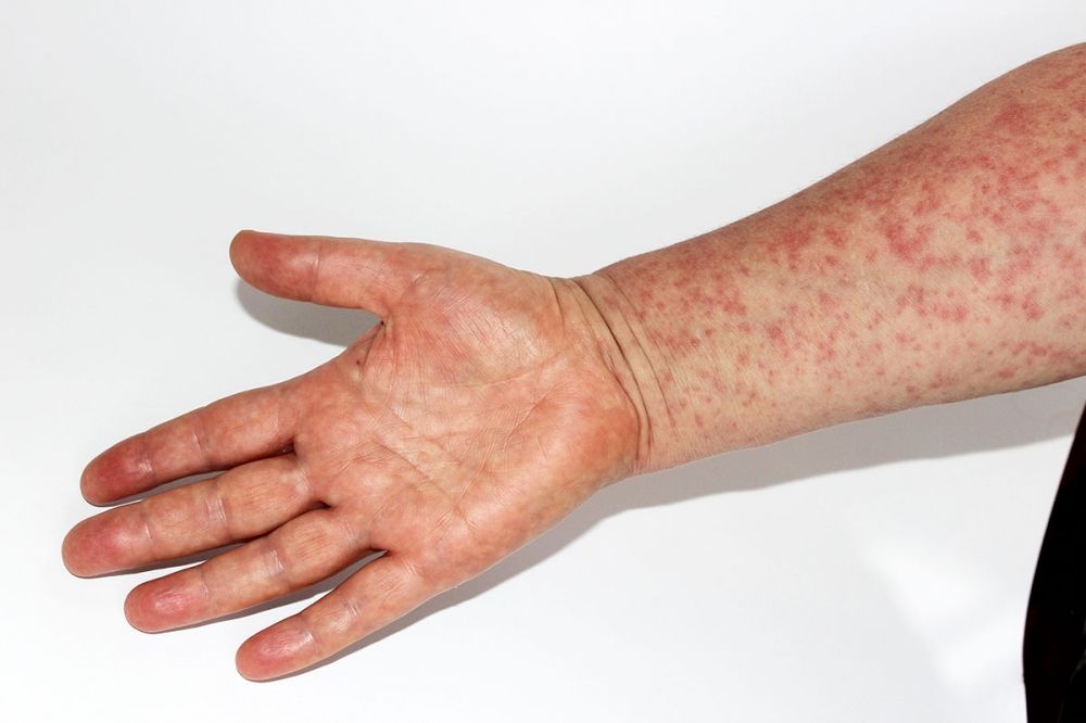 Majoriteten av de hittills smittade barnen var inte vaccinerade. (Arkivbild)