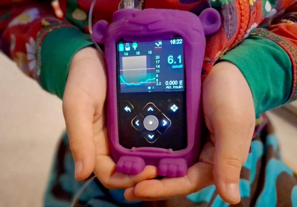 En avancerad insulinpump &auml;r ett oslagbart hj&auml;lpmedel f&ouml;r typ 1-diabetiker.
