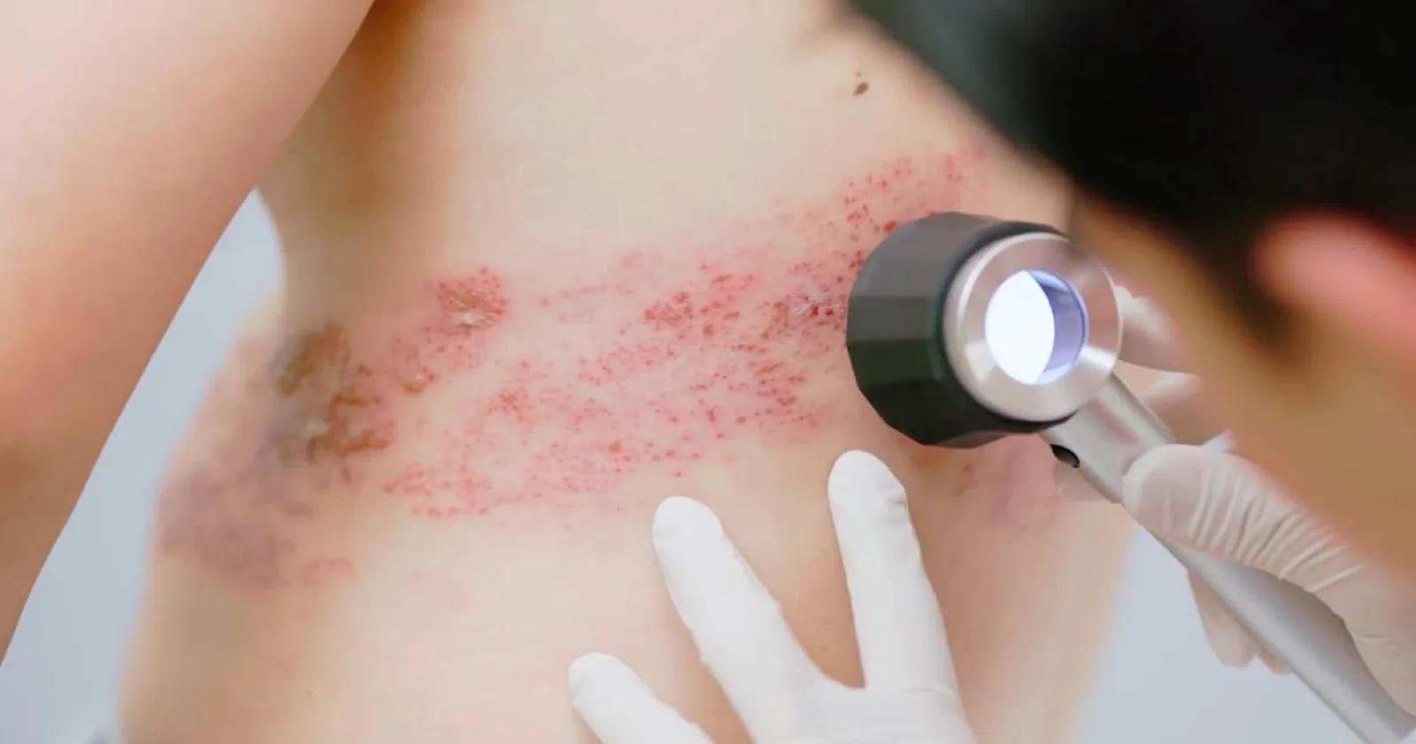 analysis of shingles from medical professional