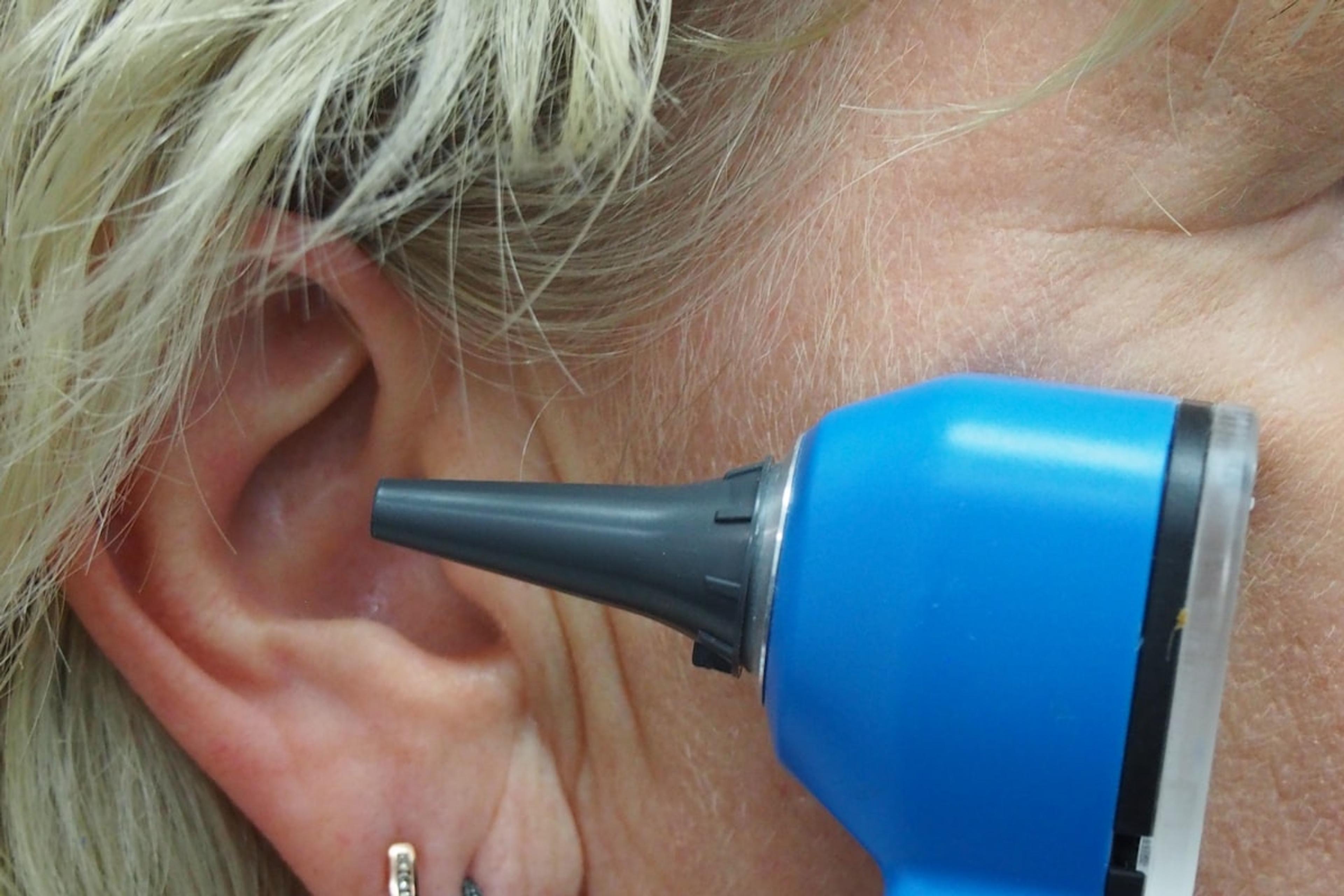 Ear Wax Removal (Both Ears)