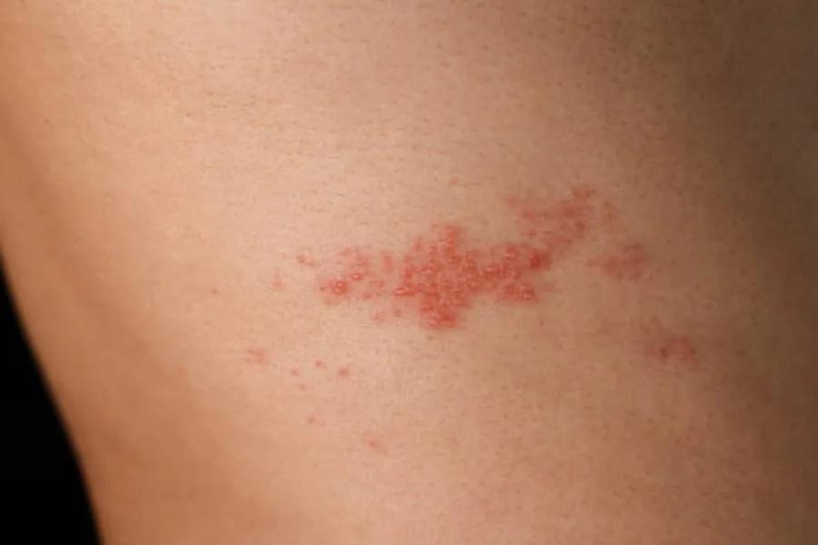Shingles Treatment