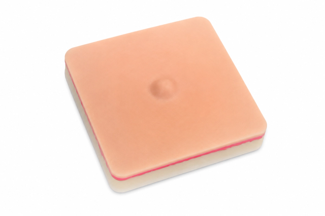 Umbilical Hernia Replacement Insert