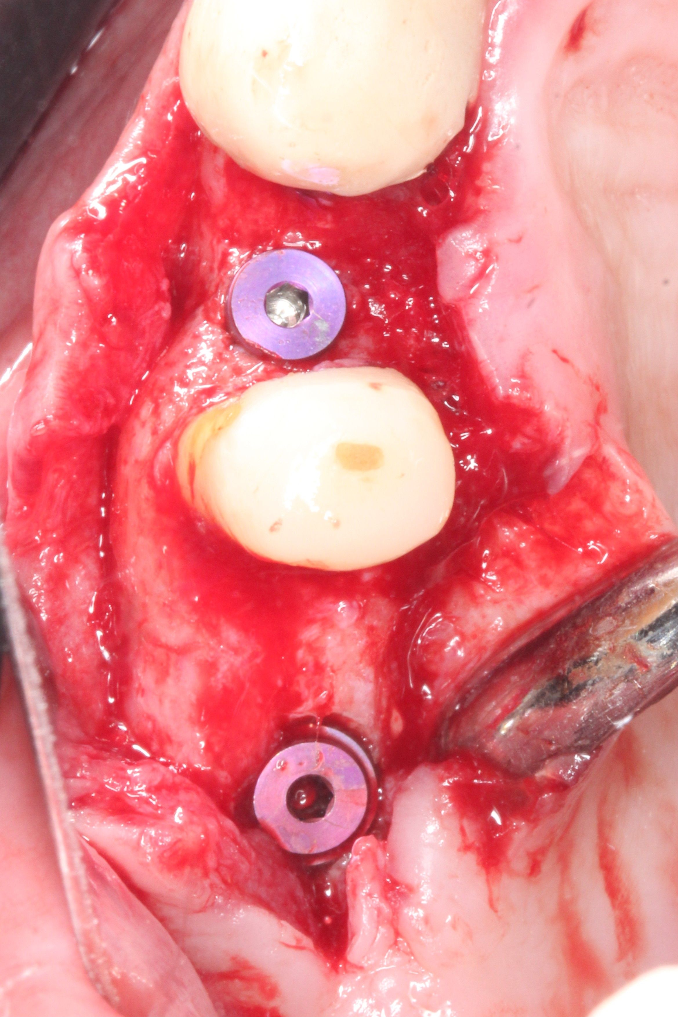 Free hand implant placement