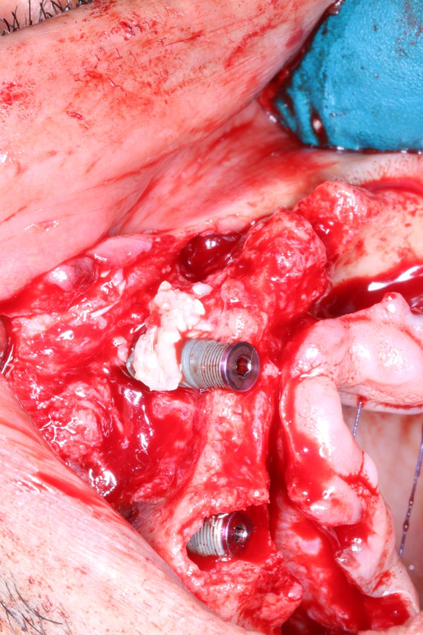 Implant maintenance protocols