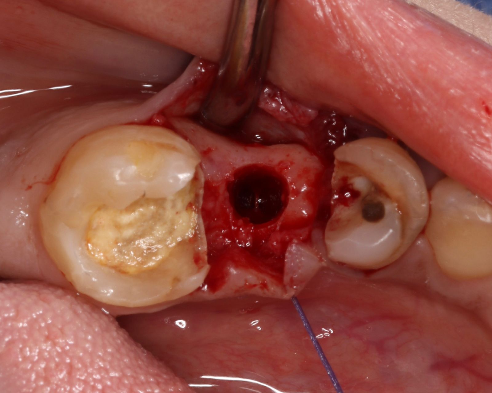 Single implant placement