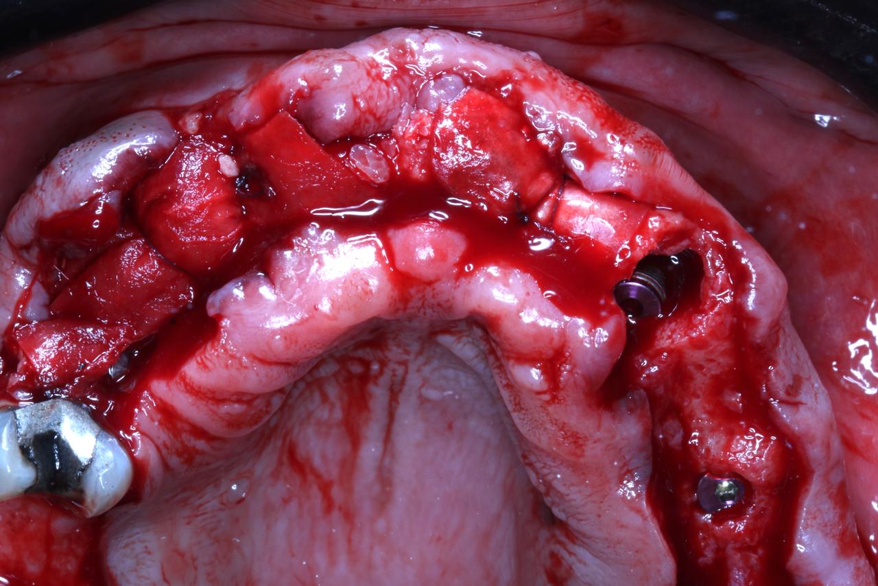Bone grafting and Membrane Application