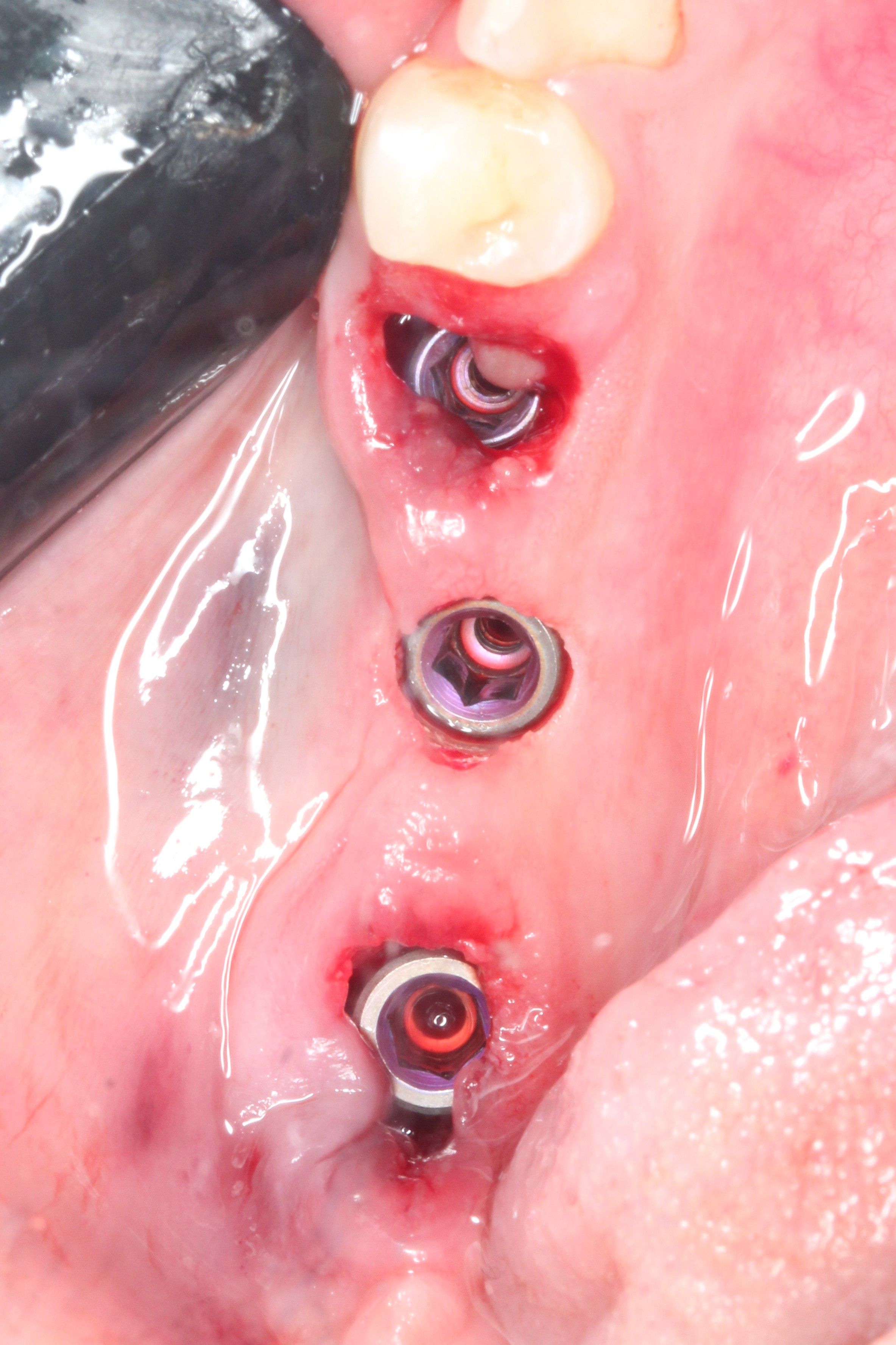 Partially Guided Implant placement in fresh extraction sockets