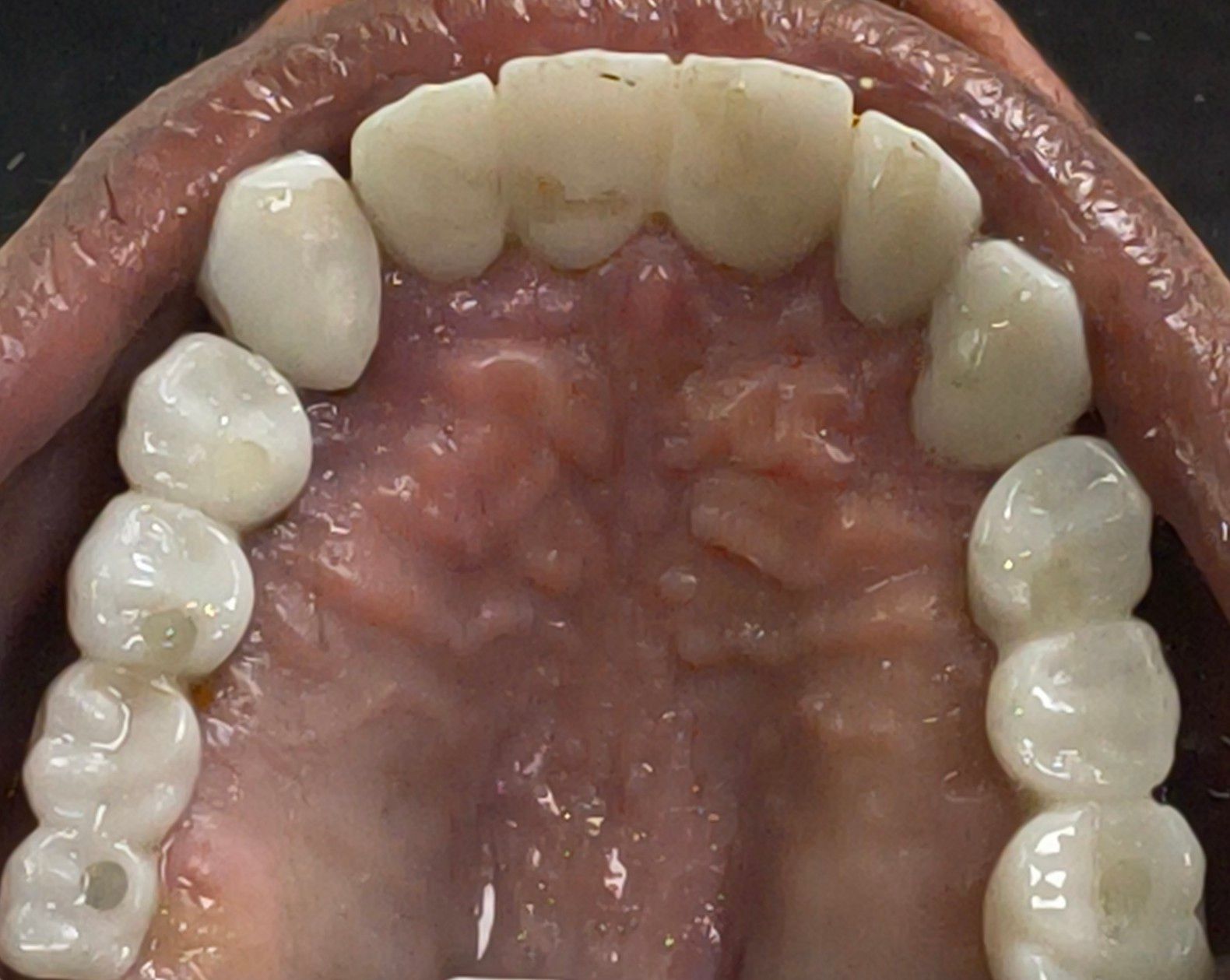 Zirconia Bridge on Implants