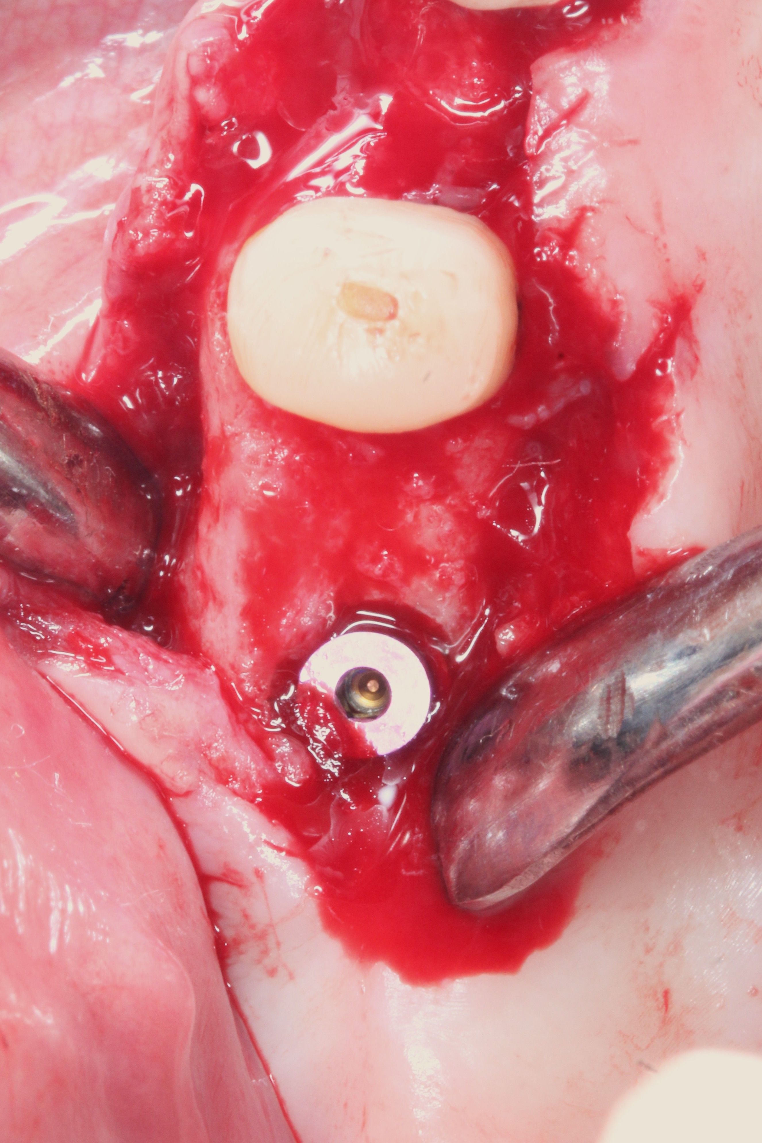 Free hand implant placement 