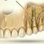 Sinus Lifting