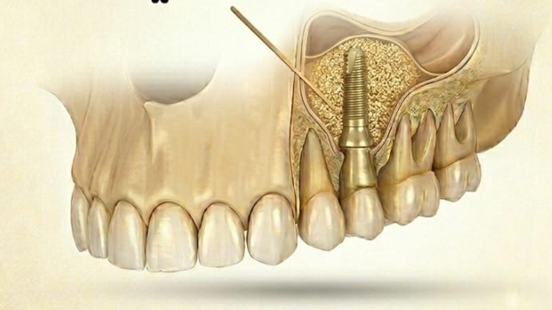Sinus Lifting