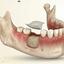 Bone Grafting
