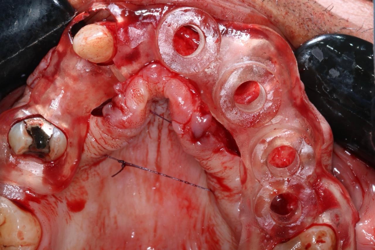 Bone Supported Guide fabrication and usage in surgery