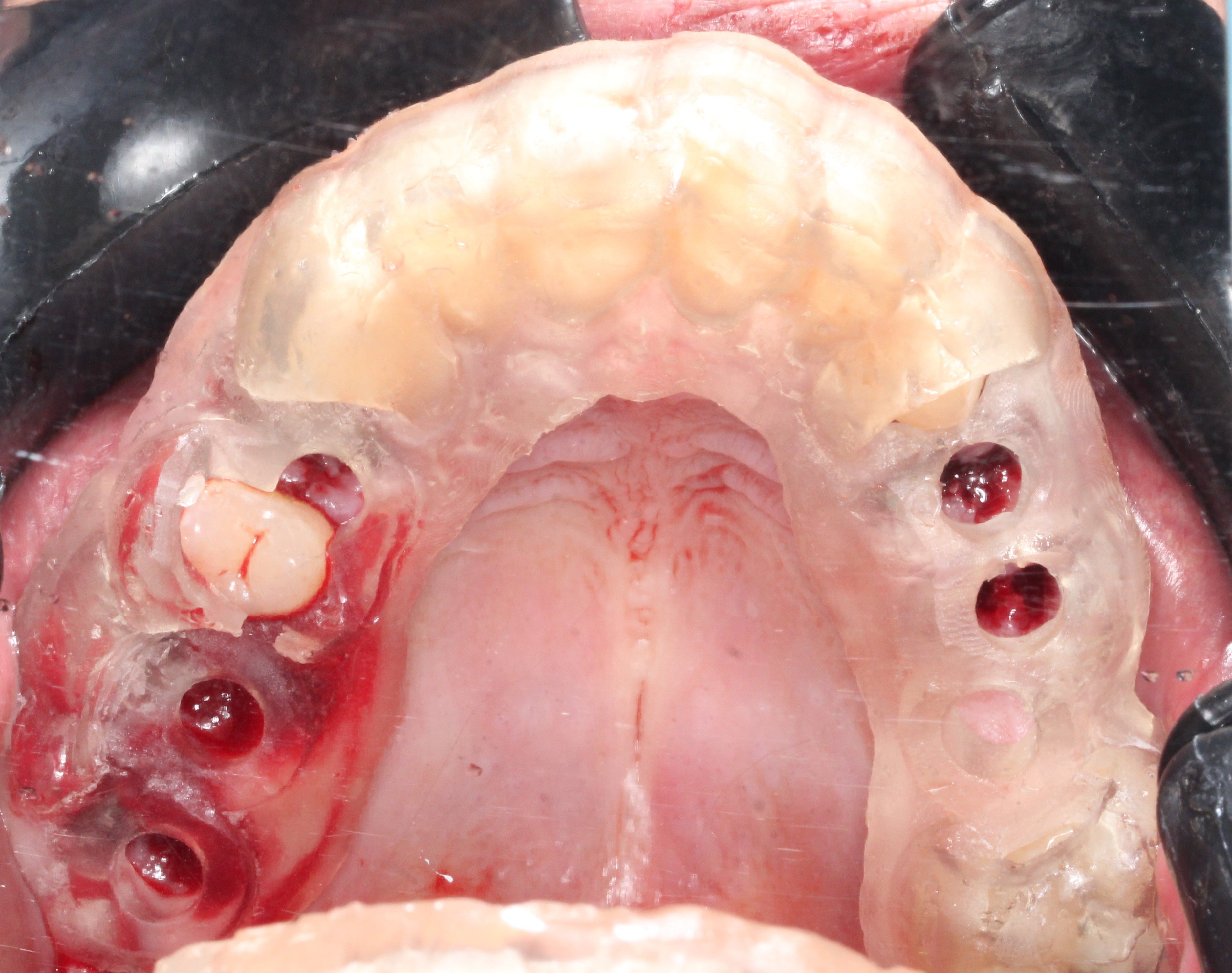 Guided surgery with immediate placement