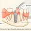 Soft tissue grafting