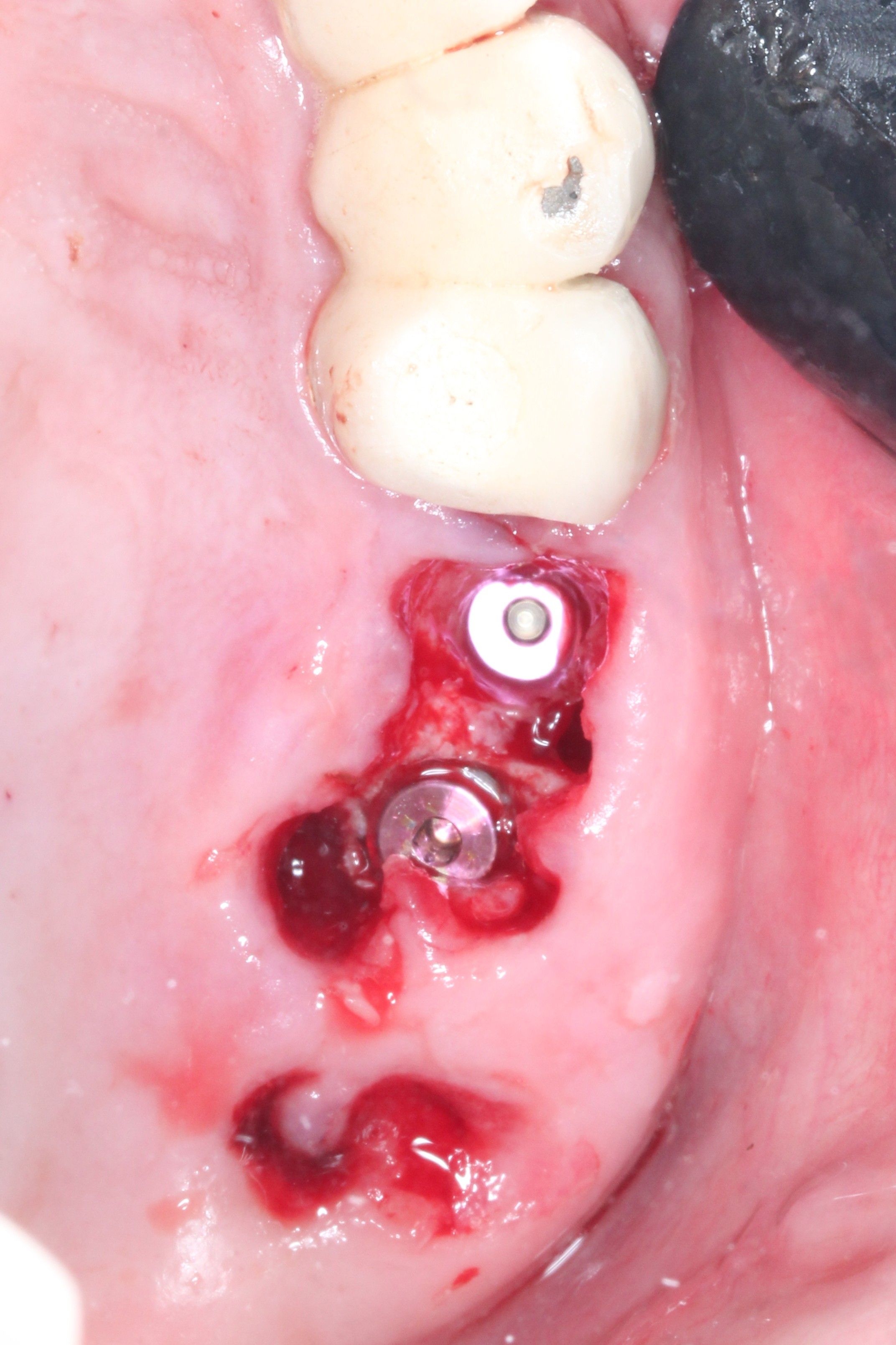 Implant placement in fresh extraction socket