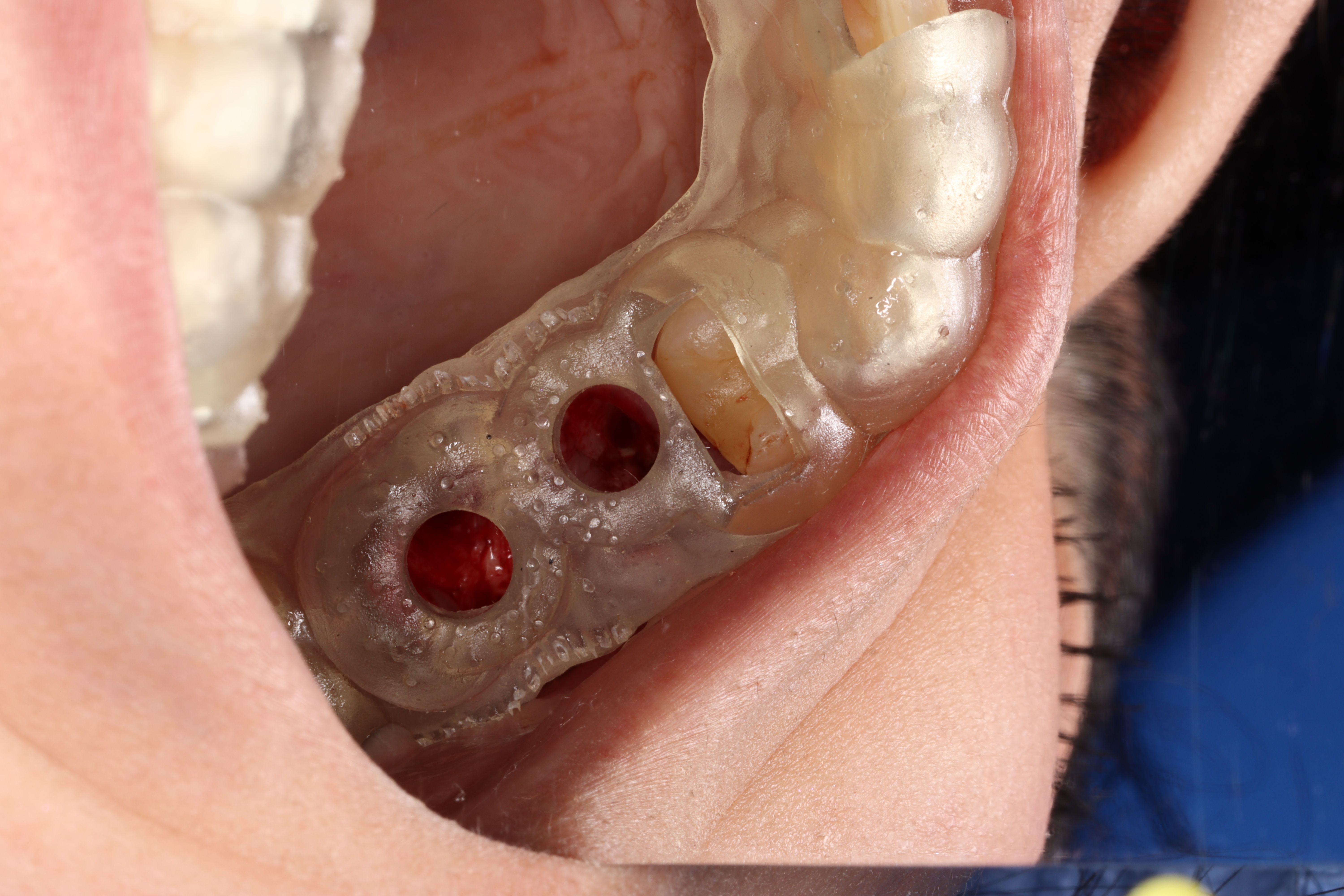 Surgical guide Implant placement