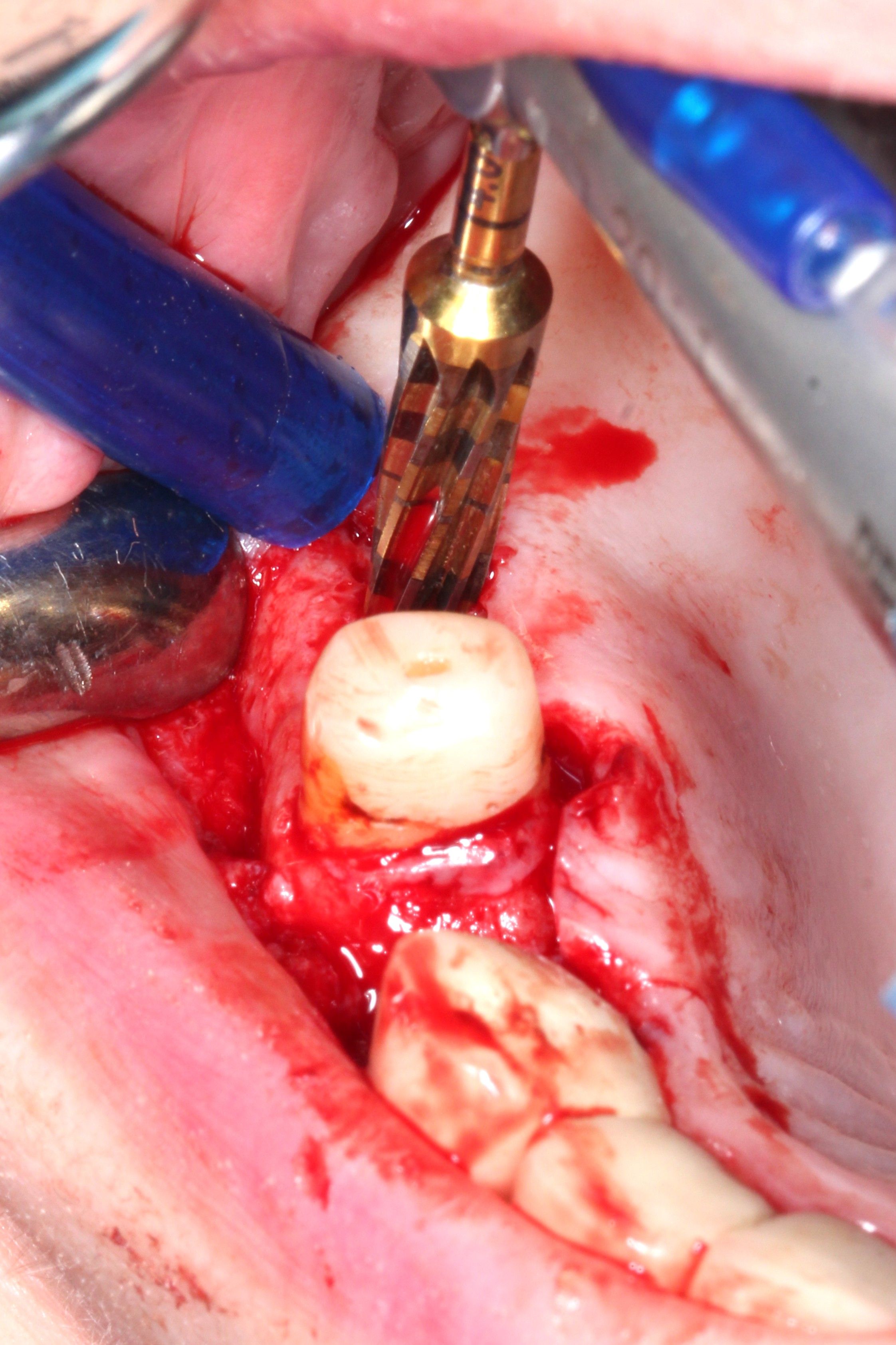 Internal Sinus lifting using Versah Protocol