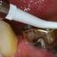 Implant maintenance