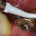 Implant maintenance