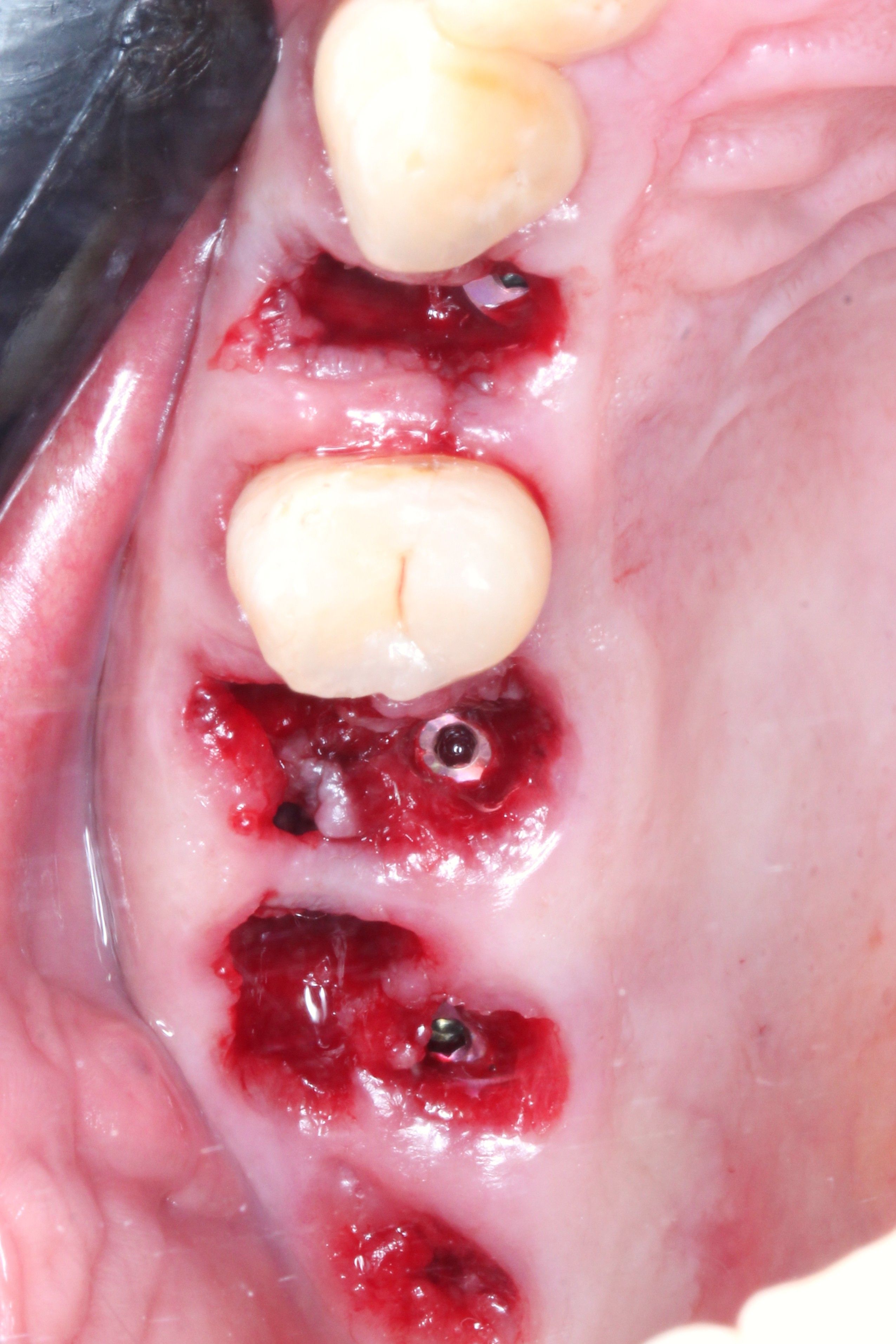 Immediate implant placement