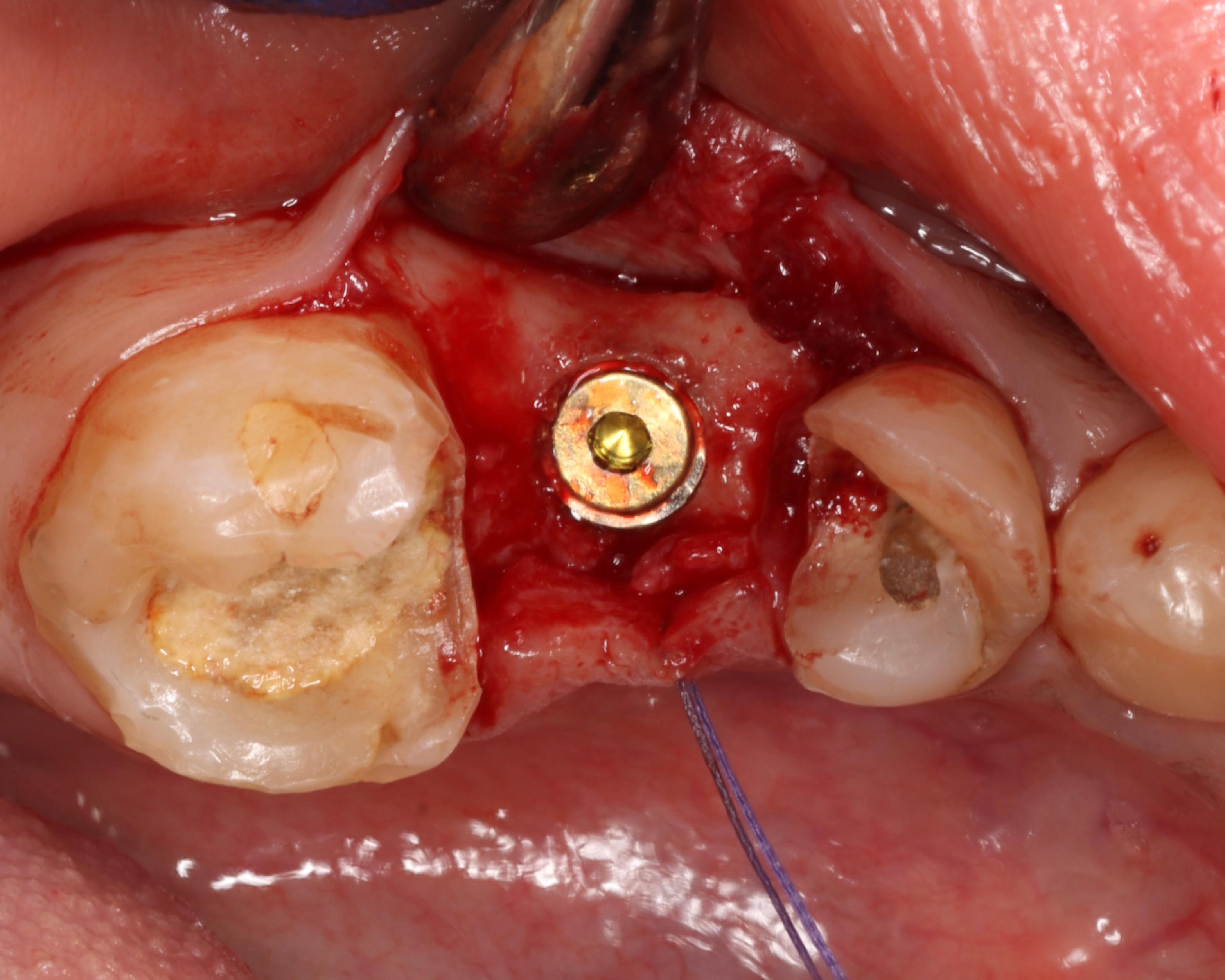 Single implant placement
