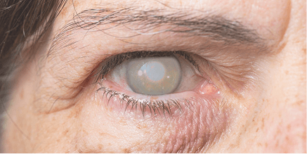 Ojo de una persona mayor con opacidad característica de cataratas