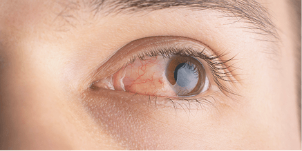 Persona mayor durante una revisión oftalmológica para detectar glaucoma