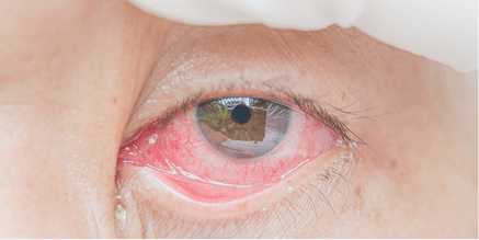 Ojo enrojecido por conjuntivitis