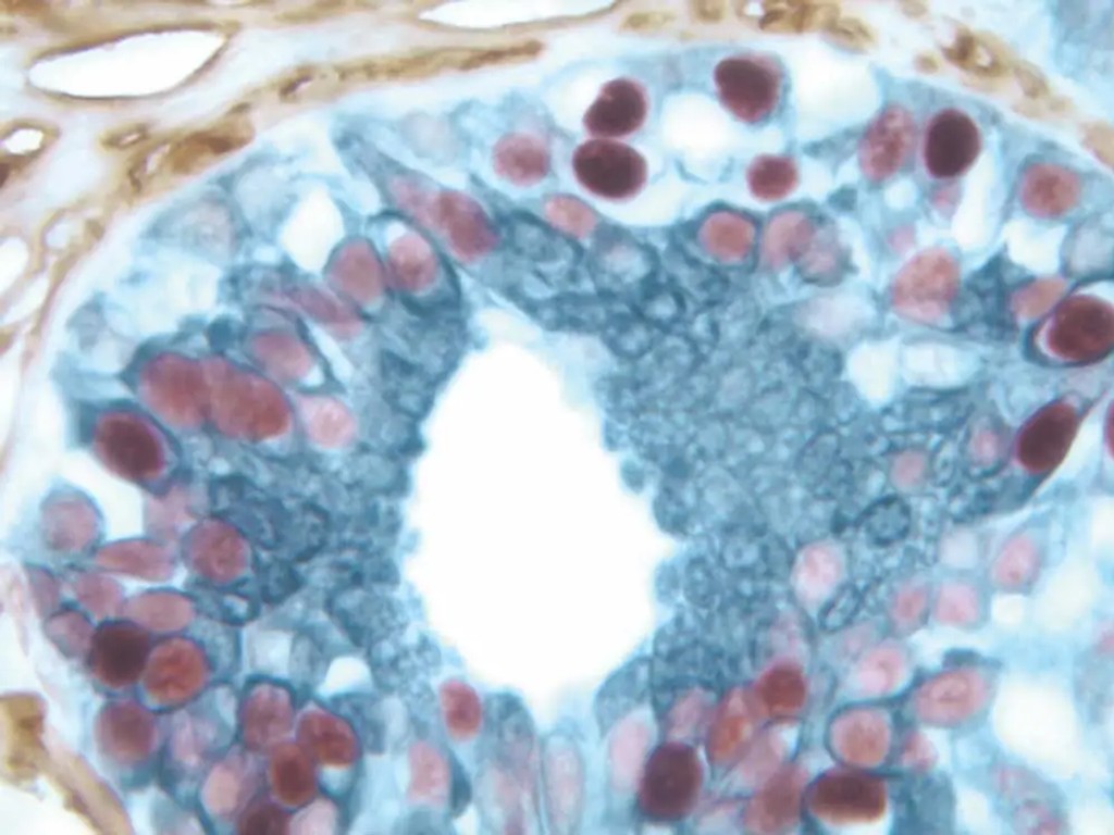 Breast Carcinoma 1