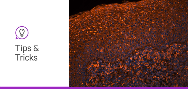 Glycosylation in the Alzheimer’s Brain: Visualizing New Paths to Diagnosis and Therapy